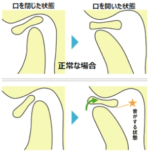 口を開いたとき音がする状態