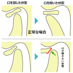口が開かない状態